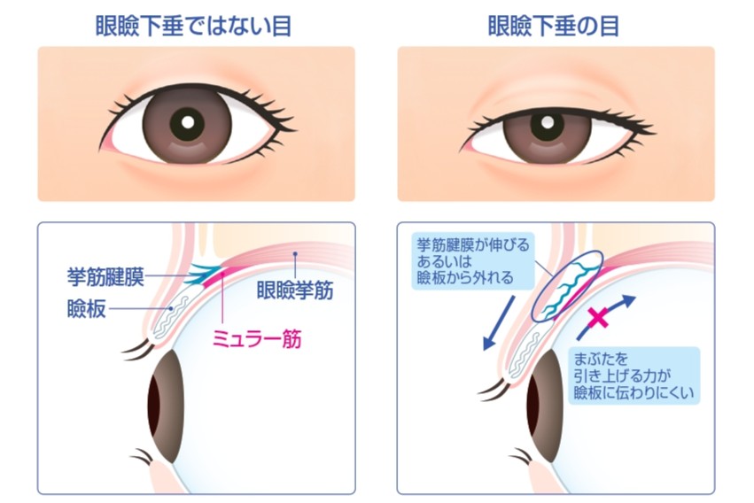 眼瞼下垂の目とまぶたの構造