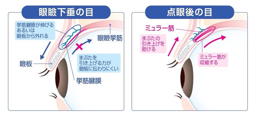 アップニークミニ点眼液の作用